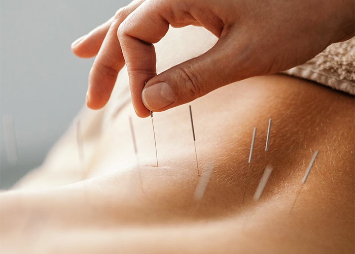 Chinese acupuncture medicine