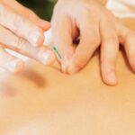 Acupuncture