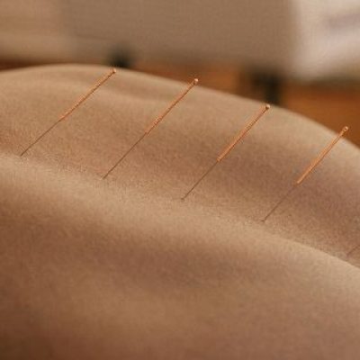 Unlocking the Mind-Body Connection: How Acupuncture Reduces Stress and Anxiety